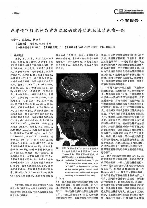 以单侧下肢水肿为首发症状的髂外动脉假性动脉瘤一例