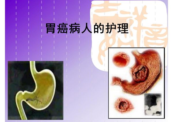 胃癌病人的护理(PPT-课件)