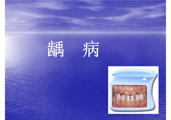 乳牙龋病 温州医学院《儿童口腔医学》