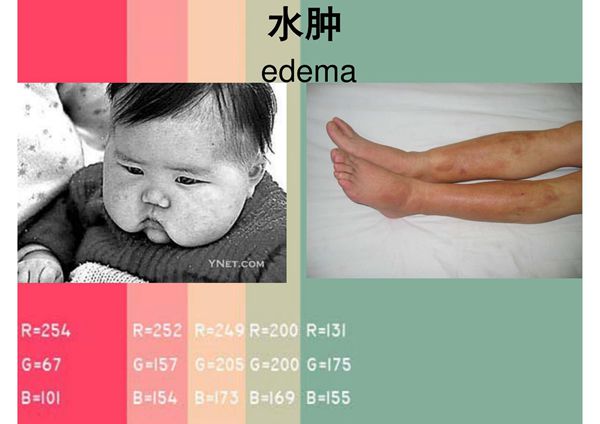 诊断学---水肿的定义 成因及鉴别
